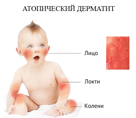Эпидемический дерматит у детей thumbnail