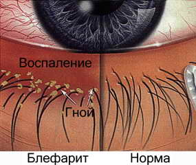Блефарит у детей