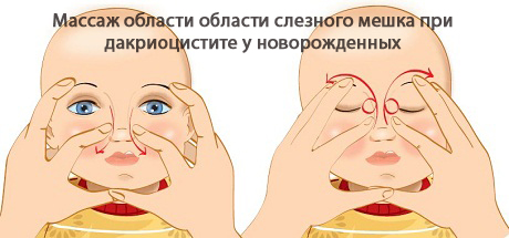 Дакриоцистит ребенку 2 года Дакриоцистит ребенку 2 года thumbnail