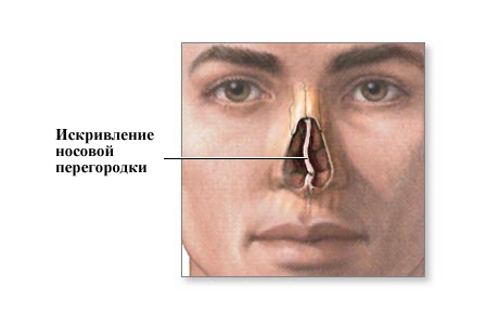 Искривление носовой перегородки у ребенка 2 года