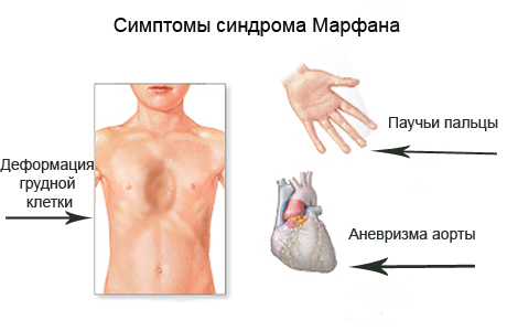 Синдром марфана лечение и предупреждение питание