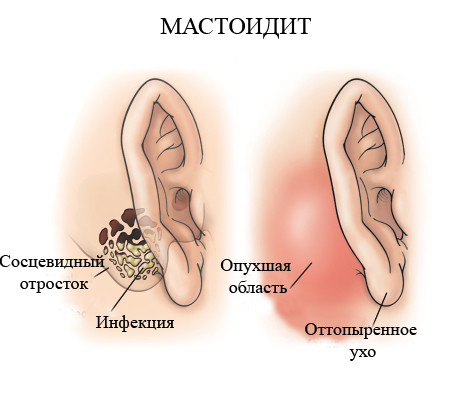 Мастоидит у ребенка 5 лет