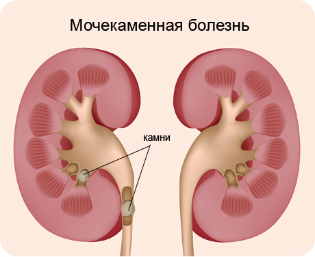 Мочекаменная болезнь (МКБ) у детей