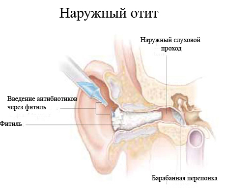 Внешний отит уха у ребенка