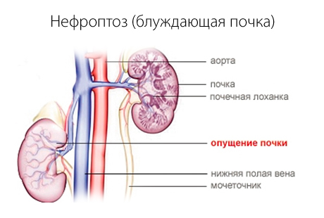 Двусторонний нефроптоз лечение народными средствами thumbnail