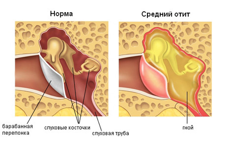 Хронический отит у ребенка последствия thumbnail