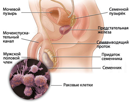 Как вылечить рак головки thumbnail