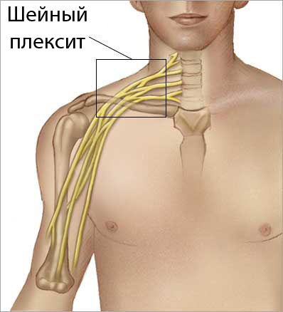 Шейный плексит
