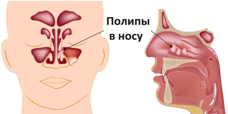 Полипы в носу и артериальное давление