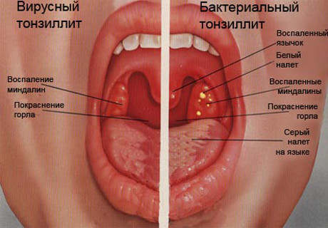 Лечение тонзиллита у ребенка