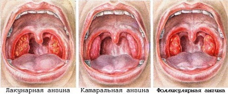 Ангина у детей