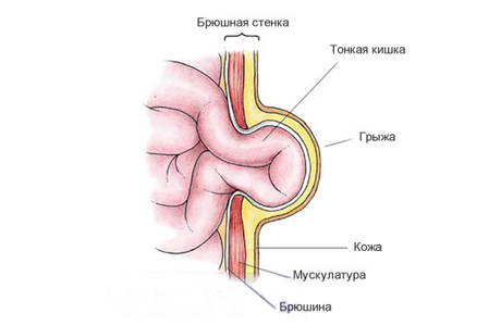 пупочная грыжа у детей