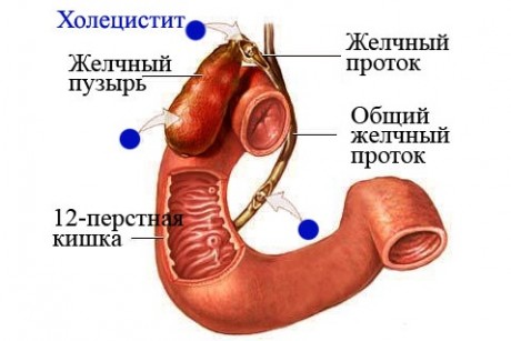 Холецистит у детей