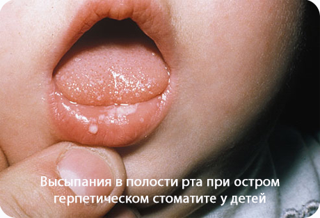 Профилактика острого герпетического стоматита у детей thumbnail