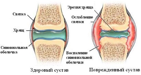 Ревматоидный артрит у детей 