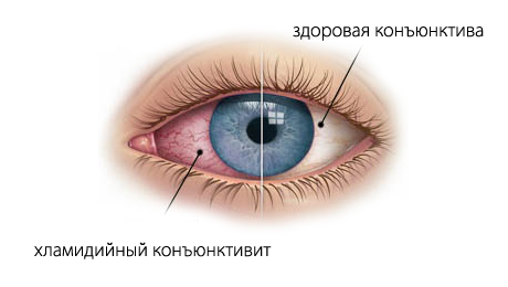 хламидийный конъюнктивит