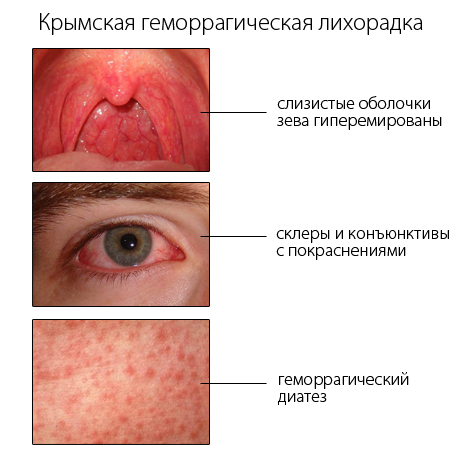 крымская геморрагическая лихорадка у детей