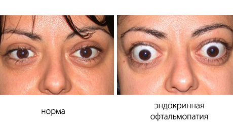 Народные средства лечения офтальмопатии thumbnail