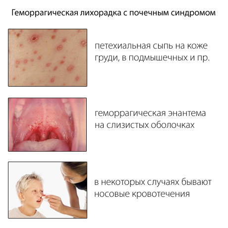 Геморрагическая лихорадка с почечным синдромом у детей thumbnail