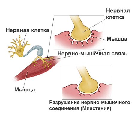 Миастенический синдром у детей симптомы thumbnail