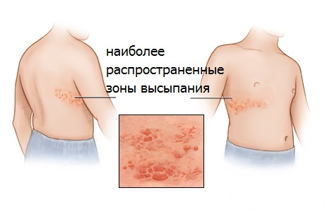 опоясывающий герпес у детей