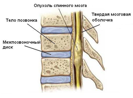 опухоли спинного мозга и позвоночника у детей