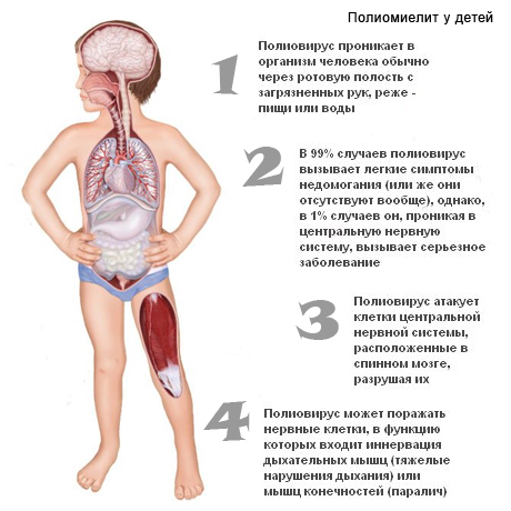 Полиомиелит