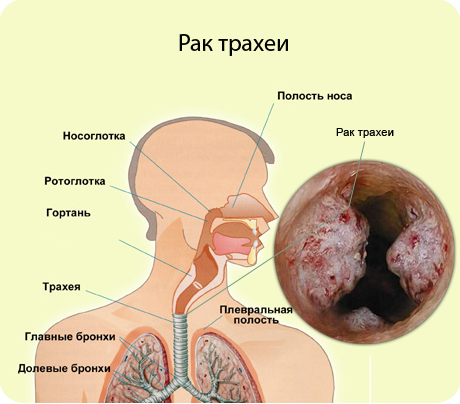 рак трахеи