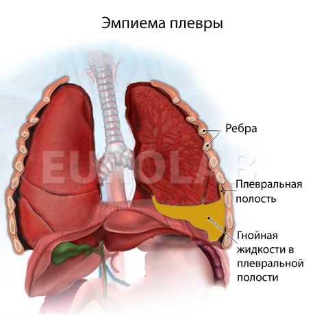 эмпиема плевры