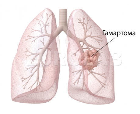 гамартома легкого