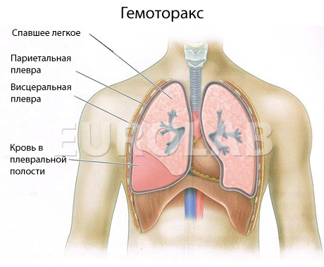 гемоторакс