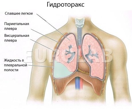 Гидроторакс легкого лечение народными средствами thumbnail