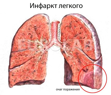 Лечение инфаркта легкого народными средствами thumbnail