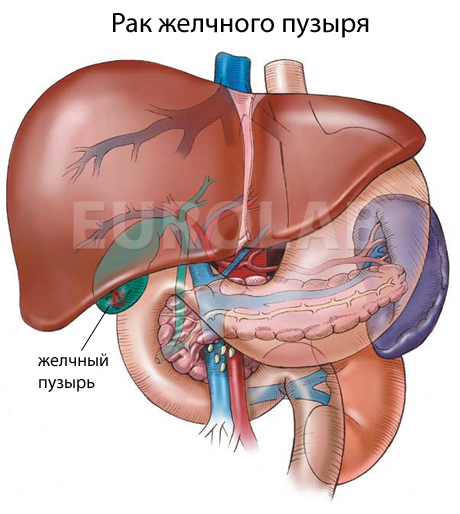 рак желчного пузыря