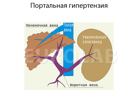 Как вылечить портальную гипертензию thumbnail