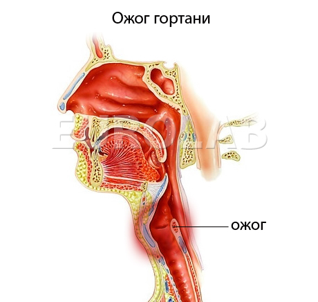 ожог гортани