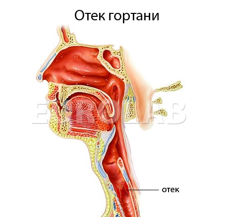 Отеки у детей история болезни thumbnail