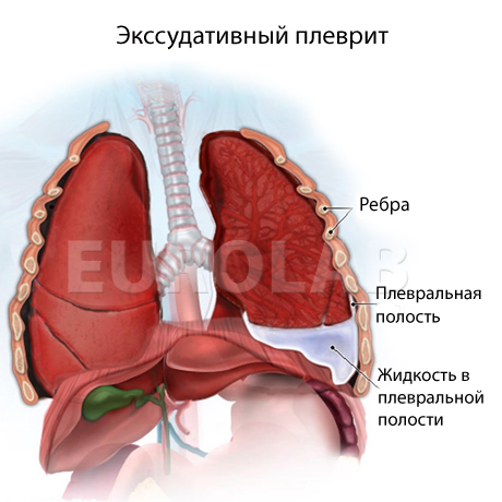 Пневмония осложненная плевритом у детей thumbnail