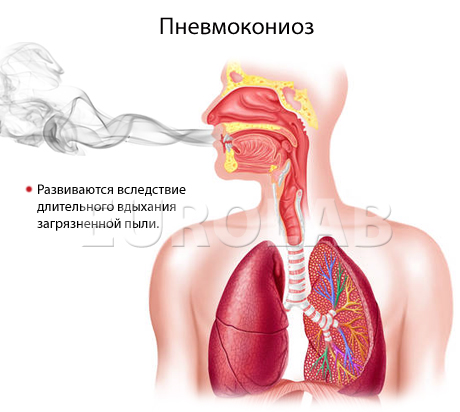 пневмокониоз