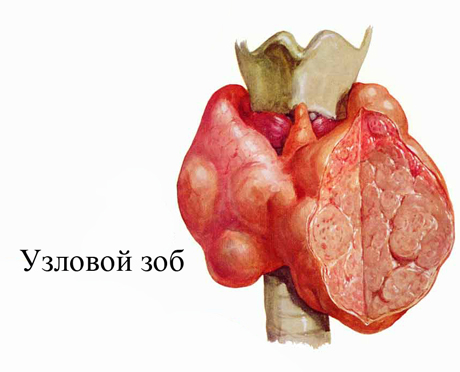 Щитовидная железа узловой зоб лечение препаратами thumbnail