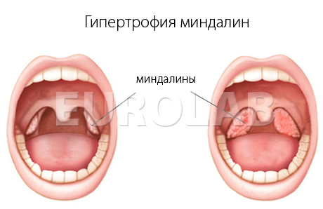 Гипертрофия небных миндалин лечение народными средствами thumbnail