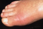 «Подагрический палец», Подагра.
Форма артрита, которая характеризуется внезапной болью, покраснением, опухолью, уплотнением чаще всего на суставе большого пальца. Подагра может появиться также на стопе, лодыжке или коленях. Причина подагры – избыточное количество мочевой кислоты  (МК) в крови, которая образует тяжелые кристаллы и откладывается в суставах. Приступы могут длиться днями и неделями. Для лечения применяются противовоспалительные средства или медикаменты, снижающие уровень МК в крови. Проконсультируйтесь у своего врача о назначении диеты, которая помогла бы снизить уровень МК в крови.