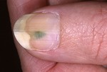 Изменение цвета ногтей.
Ногти меняют цвет? В основном причина этого – инфекция. Ногти становятся зеленоватого оттенка из-за синегнойных бактерий, а красного или черного – из-за травмы, нанесенной ногтю. Желтые ногти – редкое явление, вызванное лимфедемой или болезнью легких. Не уверены, что вызвано изменение цвета ногтей? Значит, наступило время сходить к врачу.