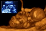 2D ультразвук (вкладыш) противопоставляется 4D ультразвуку, оба на 20 неделе беременности.
Время для ультразвука (УЗИ).
УЗИ проходят все женщины на 20 неделе беременности. Во время УЗИ врач смотрит, нормально ли развита плацента, хорошо ли она прикреплена к стенке матки, правильно ли развивается ребенок. На УЗИ также просматриваются движения тела, рук и ног малыша, а также слышно сердцебиение. На 20 неделе можно также уже определить пол ребенка.
