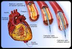 Распространенные процедуры, которые проводятся во время лечения заболевания сердца:
•	Коронарная (баллонная) ангиопластика: в закупоренную артерию вставляется тонкий катетер с крошечным шариком на конце. Когда шарик попадает в место блокировки артерии, он начинает увеличиваться, расширяя артерию, так чтобы увеличился приток кров. После этого катетер убирается.
•	Стент: установка стента похожа на коронарную ангиопластику, за исключением маленького шарика, который здесь заменяет металлическая трубка (стент), которая остается в артерии и держит артерию постоянно открытой (в отличие от шарика и катетера, которые не остаются в артерии).
•	Атерэктомия: устройство, похожее на дрель, или лазер убирает бляшки, закупоривающие артерии. 
•	Близкофокусная лучевая терапия (брахитерапия): радиация применяется для профилактики повторного появления бляшек в артериях после ангиопластики.