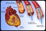 Распространенные процедуры, которые проводятся во время лечения заболевания сердца:
•	Коронарная (баллонная) ангиопластика: в закупоренную артерию вставляется тонкий катетер с крошечным шариком на конце. Когда шарик попадает в место блокировки артерии, он начинает увеличиваться, расширяя артерию, так чтобы увеличился приток кров. После этого катетер убирается.
•	Стент: установка стента похожа на коронарную ангиопластику, за исключением маленького шарика, который здесь заменяет металлическая трубка (стент), которая остается в артерии и держит артерию постоянно открытой (в отличие от шарика и катетера, которые не остаются в артерии).
•	Атерэктомия: устройство, похожее на дрель, или лазер убирает бляшки, закупоривающие артерии. 
•	Близкофокусная лучевая терапия (брахитерапия): радиация применяется для профилактики повторного появления бляшек в артериях после ангиопластики.