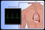 Что такое электрокардиограмма (ЭКГ)?
Здоровое сердце работает как «электрический насос» и нуждается в сильном притоке крови, для обеспечения организма «электричеством». У людей же с заболеваниями сердца приток крови слабый, поэтому сердце обеспечивает организм «электричеством» плохо. Электрокардиограмма (ЭКГ) – неразрушающий (безвредный) анализ, при котором измеряется электрическая активность сердца. ЭКГ занимает около 5 минут и это абсолютно безболезненная процедура. Кроме того, с помощью ЭКГ могут быть обнаружены и симптомы других нарушениях работы сердца, например:
•	Анормальные сердечные ритмы.
•	Признаки прошедшего сердечного приступа.
•	Признаки надвигающегося сердечного приступа.
•	Нестабильная стенокардия.
•	Врожденный порок сердца.
•	Признаки ненормального состояния электролитов в крови.
•	Признак воспалительных процессов в сердце (миокардит, перикардит).