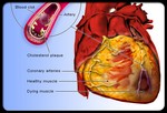 Связь между заболеваниями сердца и сердечным приступом.
Бляшки в артериях вызывают образование сгустков крови в коронарной артерии. Кровяные сгустки не дают крови поступать к сердечной мышце, что и приводит к сердечному приступу. В худшем случае происходит остановка сердца или нарушение ритма несовместимое с жизнью.