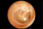 Диагностика инфекционного заболевания уха.
Для того, чтобы обнаружить заболевание, врач осматривает внешнее ухо с помощью специального прибора – отоскопа. Здоровая барабанная перепонка (как на этой картинке) выглядит немного просвечивающейся и имеет розовато-серую окраску. Вздутость (припухлость) и красный цвет перепонки свидетельствуют о наличии инфекции.