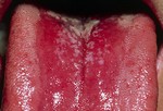Обветренные губы провоцируют кандидозный стоматит.
Кандидозный стоматит вызывается дрожжевыми грибами рода Candida  и наиболее часто встречается у пожилых людей и маленьких детей. Но ослабленная иммунная система, антибиотики, диабет и определенные медицинские препараты, такие как спреевые кортикостероиды, существенно способствуют развитию этого заболевания. Стирание пятен очень болезненно, поэтому нужно проконсультироваться с врачом.